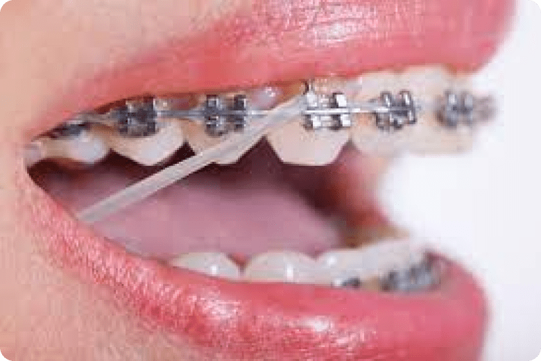 치아교정 고무줄 사용 시기