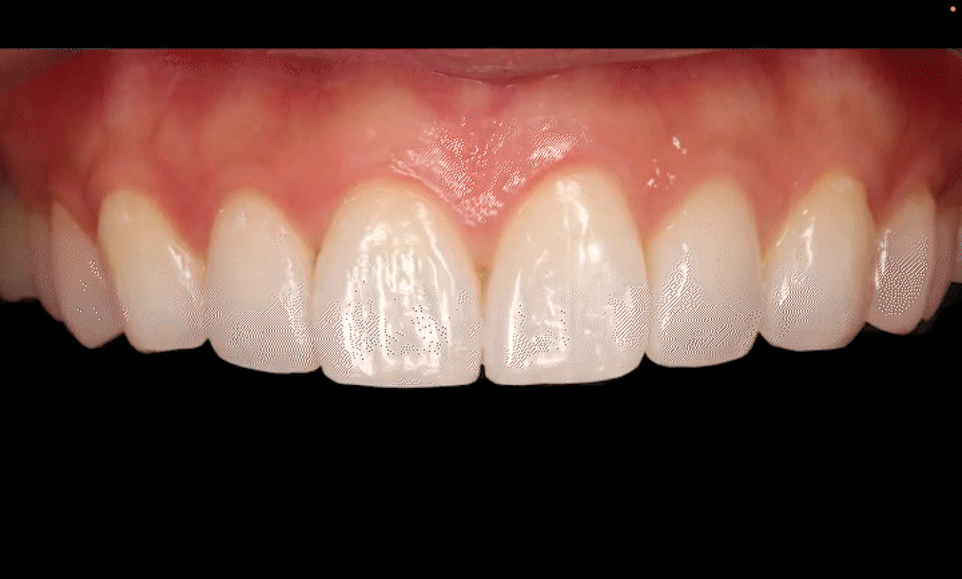 더스퀘어치과 | 이갈이 습관등에 의한 치아의 마모 진행 과정