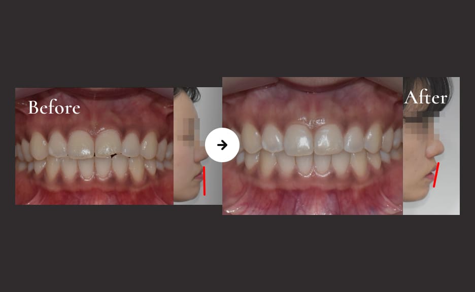 더스퀘어치과 | 옆모습 프로파일 개선법 돌출된 치아 형태 개선