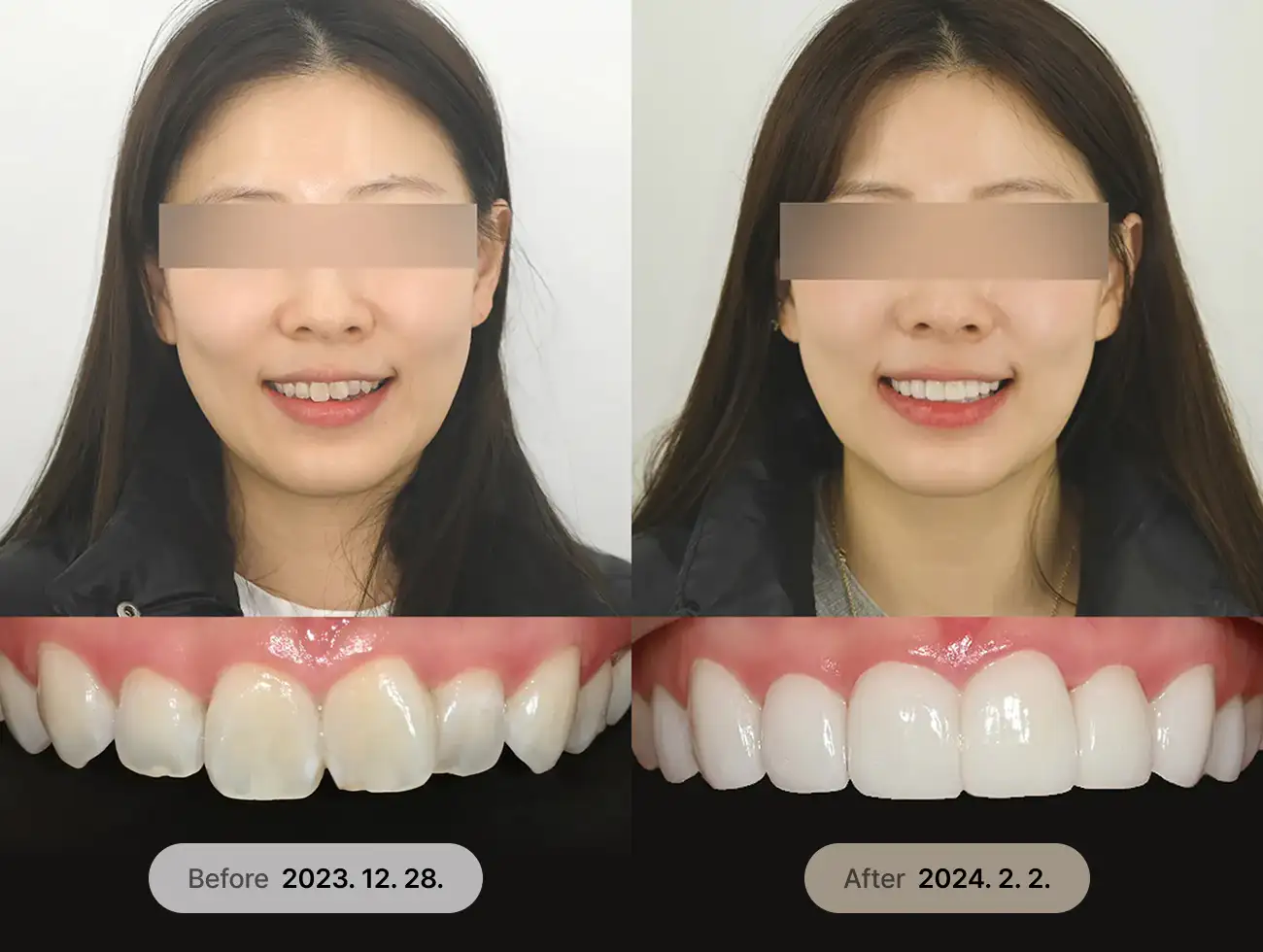 비니어큐브 Veneer 비포애프터 사례 1