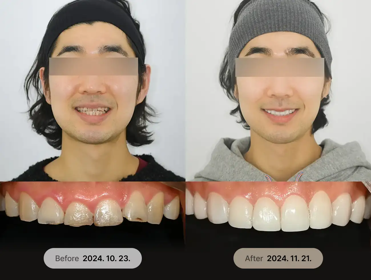 비니어큐브 Veneer 비포애프터 사례 2