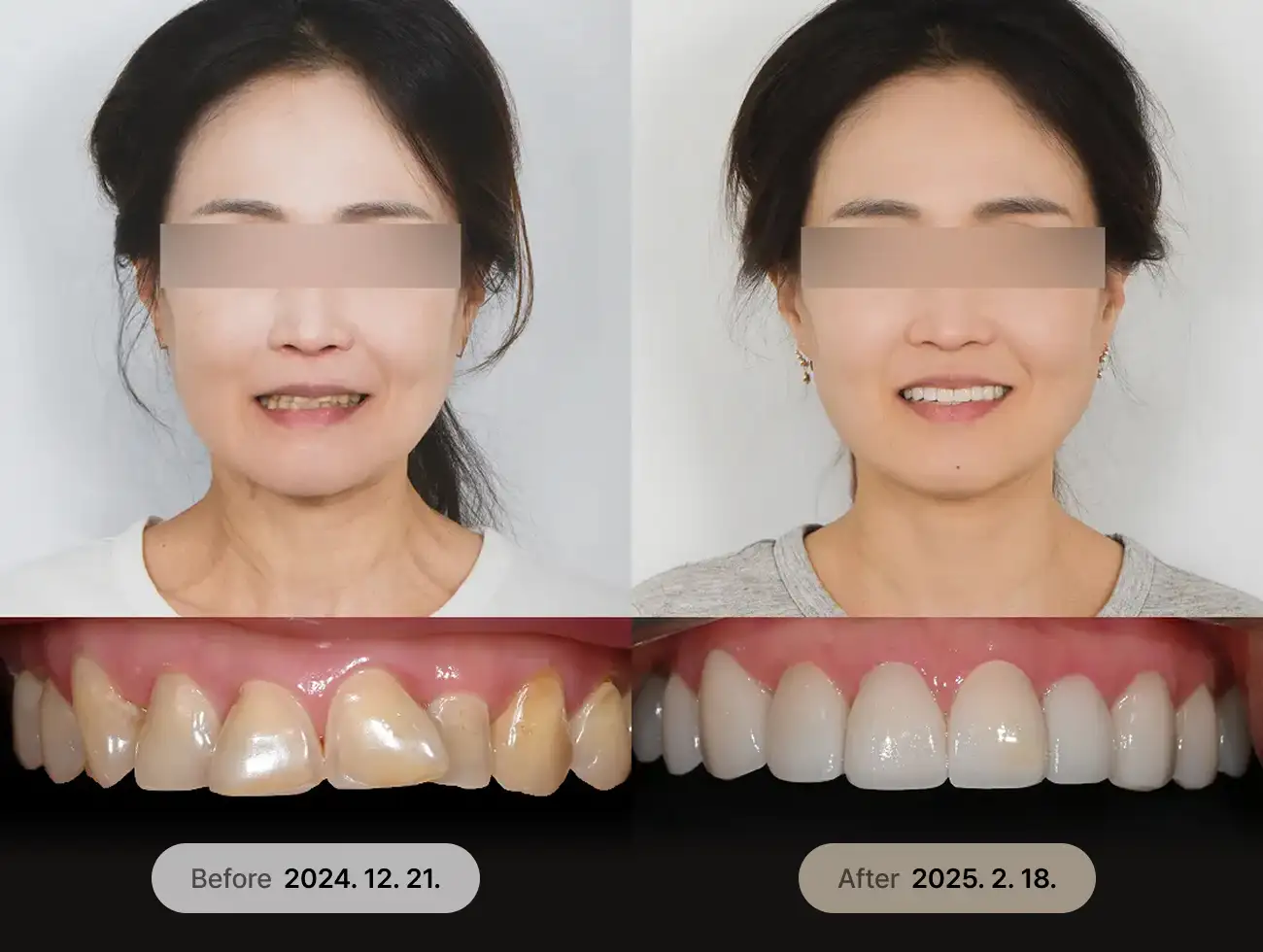 비니어큐브 Veneer 비포애프터 사례 3