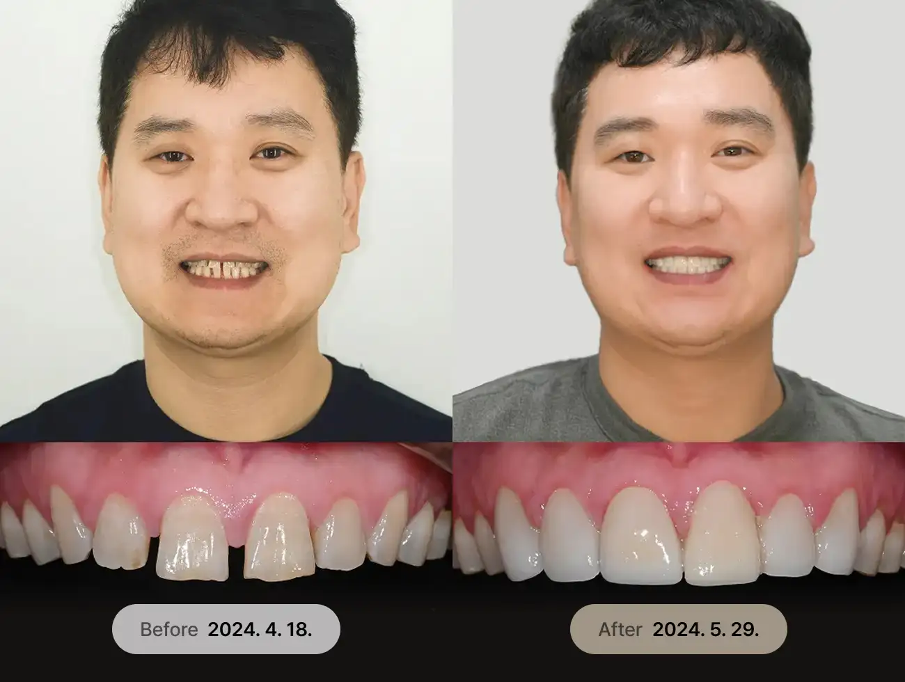 비니어큐브 Veneer 비포애프터 사례 4