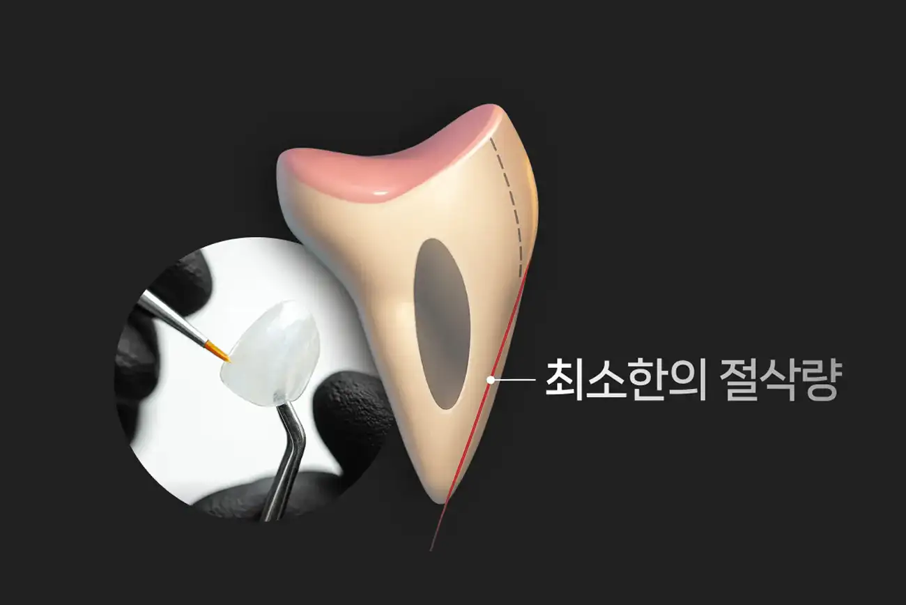 비니어큐브 이런 분들께 추천 | 과도한 치아 삭제 없이 아름다워지기를 원하는 분