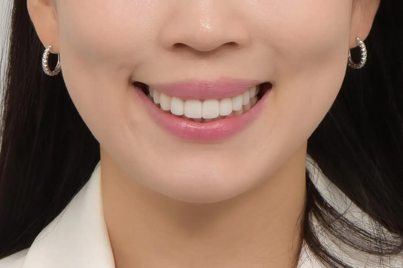 교정 후 치아가 틀어지고 벌어져 신경 쓰이시는 분 | 교정 후 고민도 Veneer³ 비니어큐브로 해결