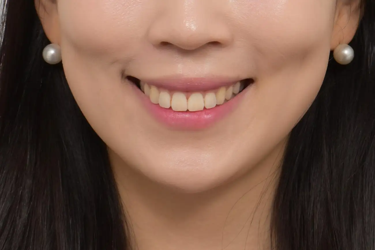과도한 치아 삭제 없이 아름다워지기를 원하는 분 | 교정 후 고민도 Veneer³ 비니어큐브로 해결