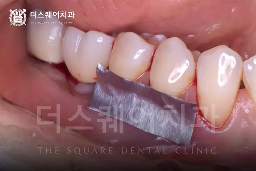 자연치 잇몸이식이 필요한 경우 | 잇몸퇴축 저항성 향상
