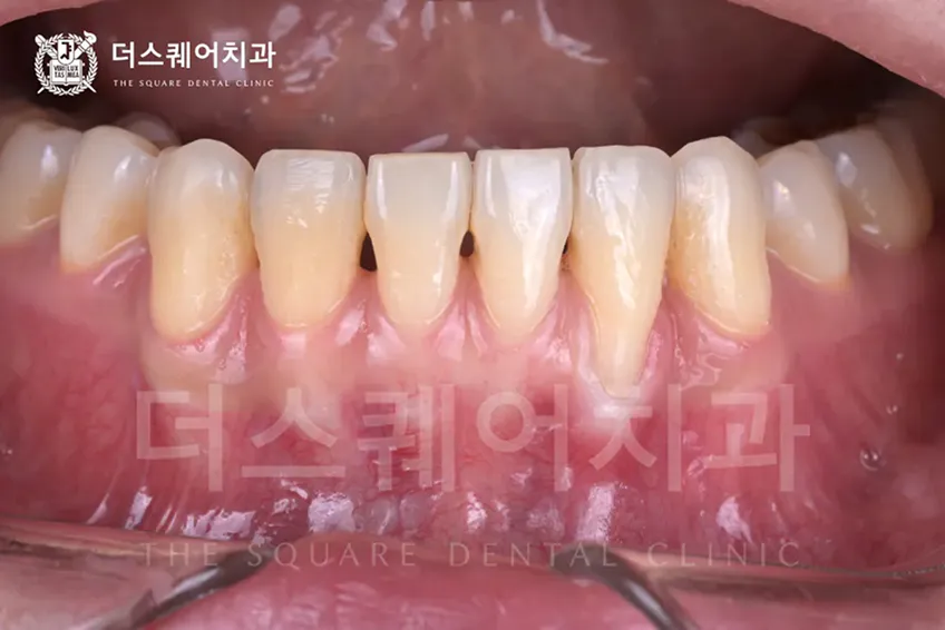 자연치 잇몸이식이 필요한 경우 | 치주염 저항성 향상