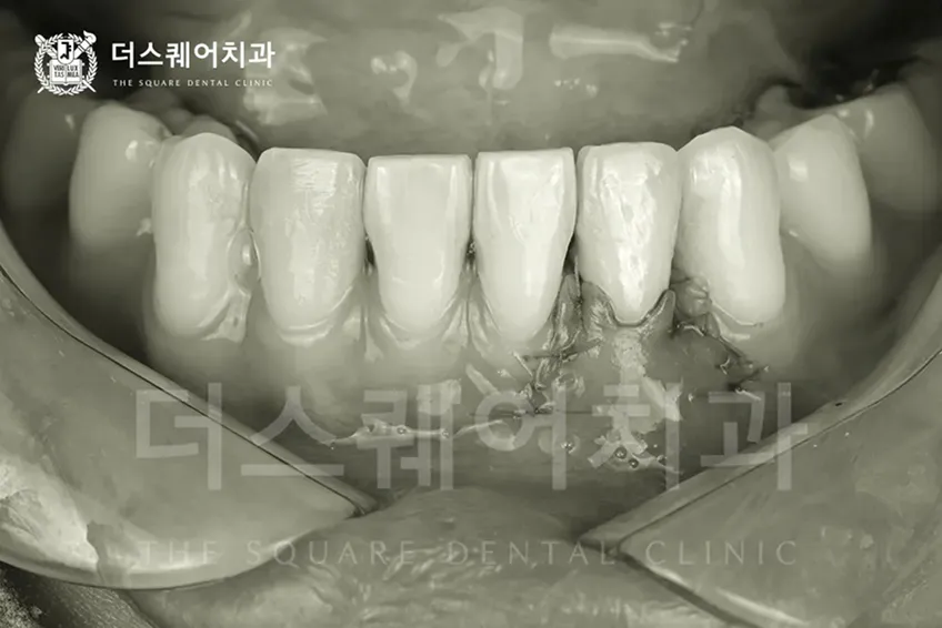 자연치 잇몸이식이 필요한 경우 | 치주염 저항성 향상