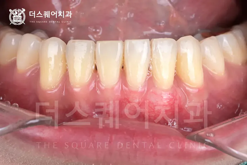 자연치 잇몸이식이 필요한 경우 | 치주염 저항성 향상