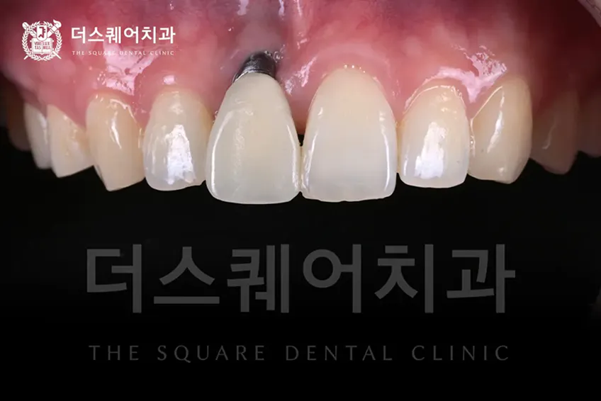 임플란트 잇몸이식이 필요한 경우 | 임플란트 보철물 심미 증진