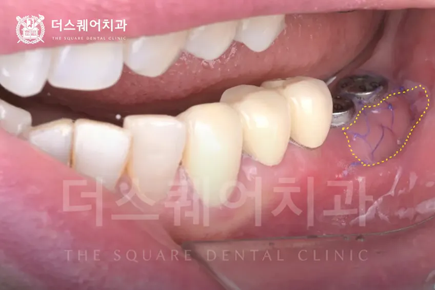 임플란트 잇몸이식이 필요한 경우 | 임플란트 주위염 방지