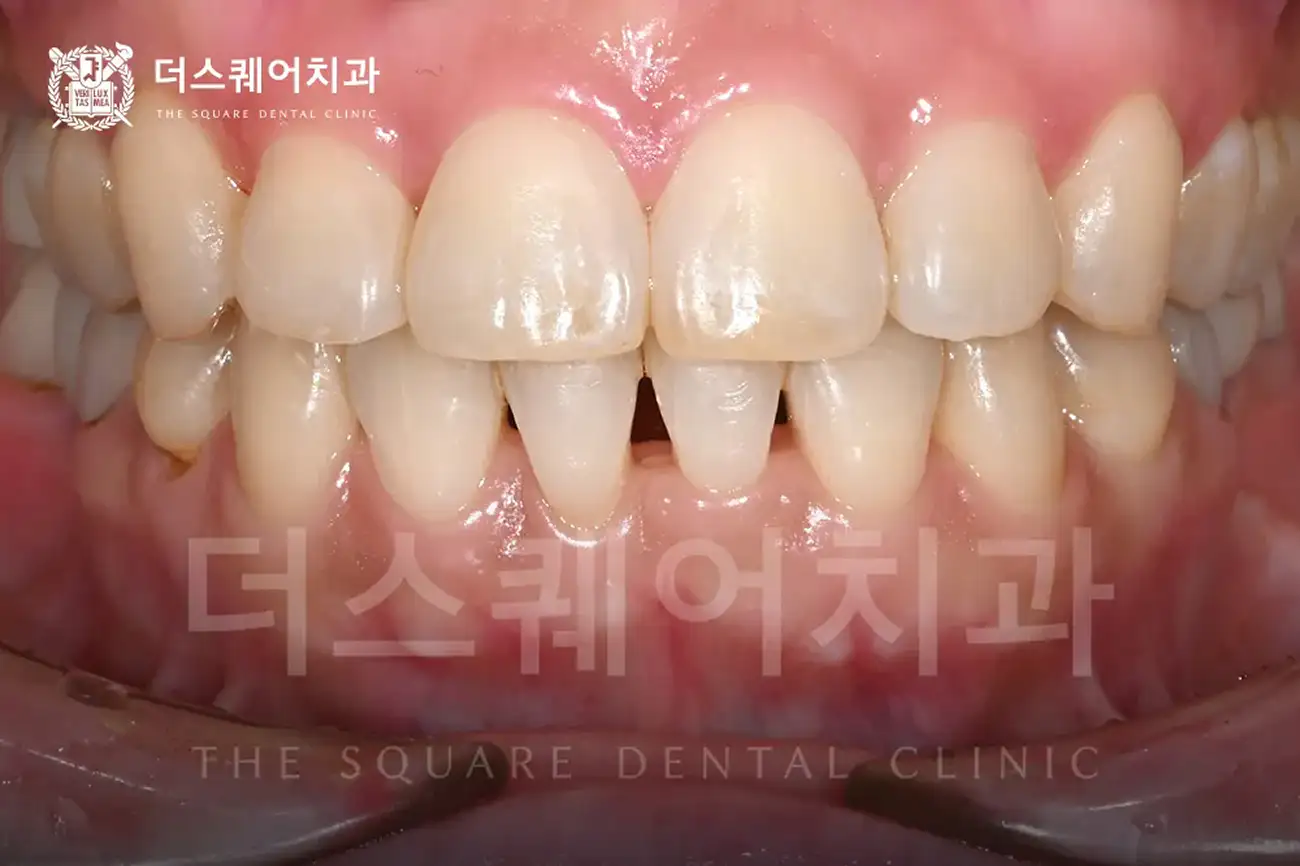 잇몸필러주사 (히알루론산 주사) | 블랙 트라이앵글 Black Triangle