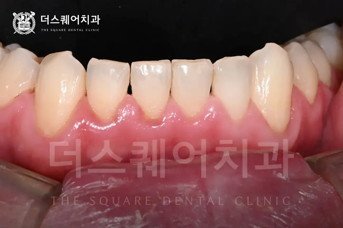잇몸필러주사 (히알루론산 주사) | 음식물 끼임 Food Impaction