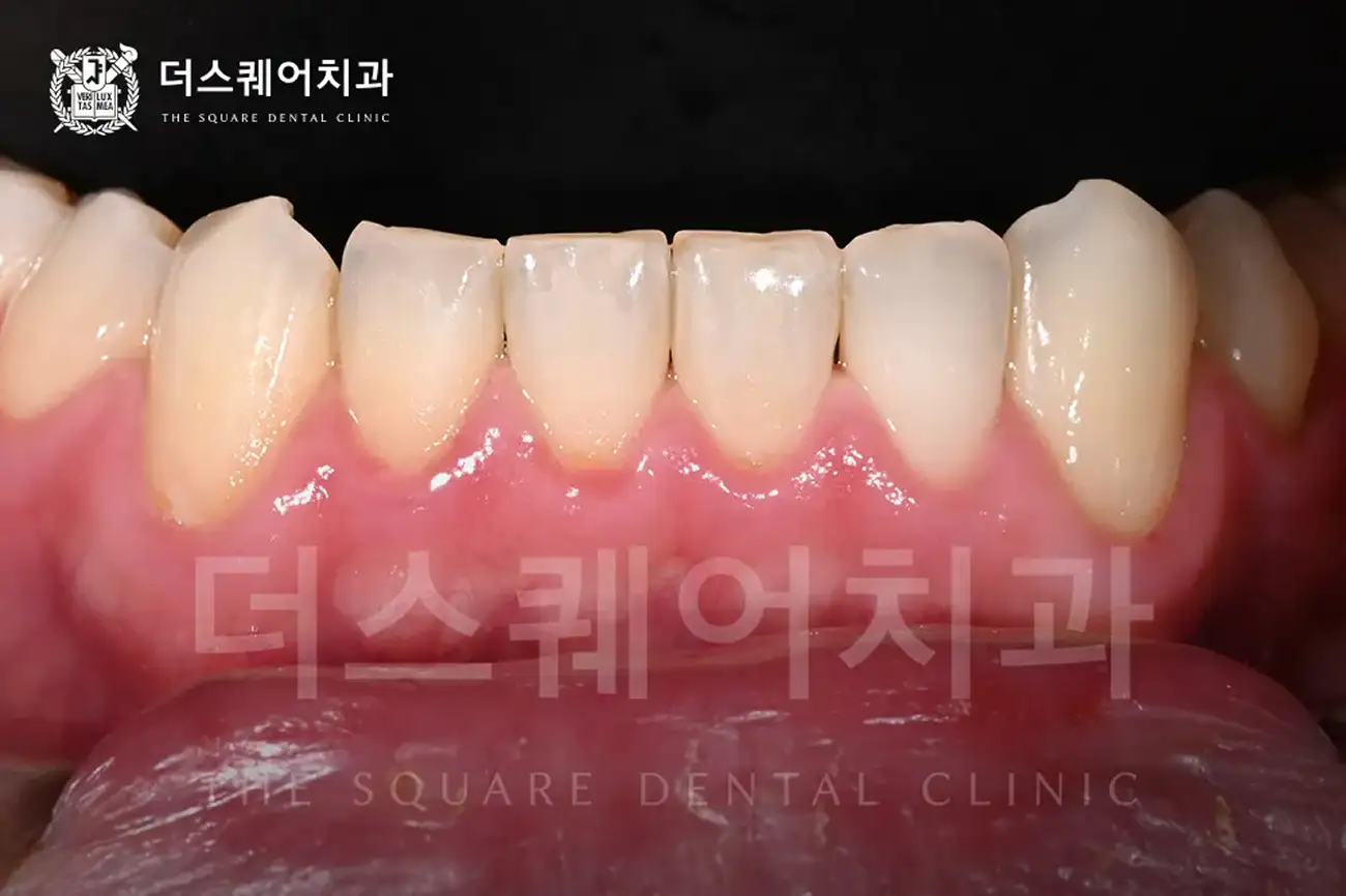 잇몸필러주사 (히알루론산 주사) | 음식물 끼임 Food Impaction