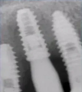 Implant surgery