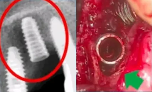 3Ms after implantation