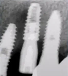 6Ms after implantation