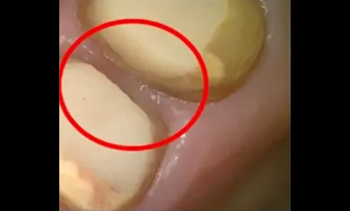 6wks after PDRN injection (5th)