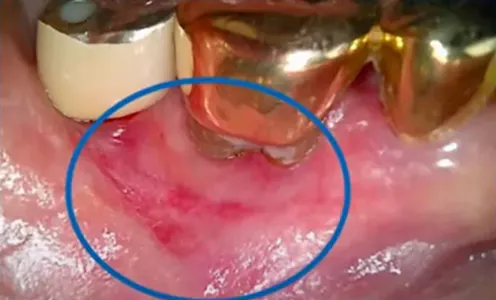 2Ms after PDRN injection