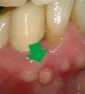 6Ms after PDRN injection