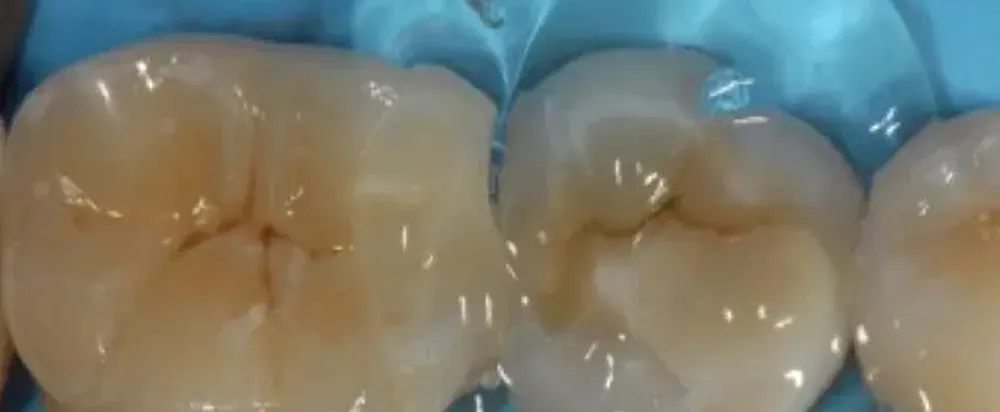 오래가는 인레이를 위한 테크닉 | 산소 저해층 제거 Oxygen Inhibition Layer, OIL