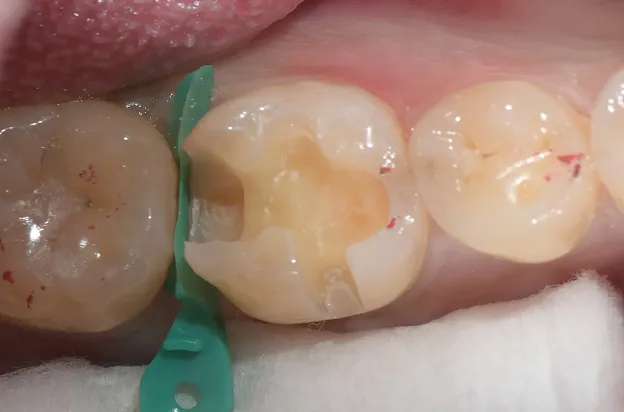 오래가는 인레이를 위한 테크닉 | 레진 코팅 Resin Coating