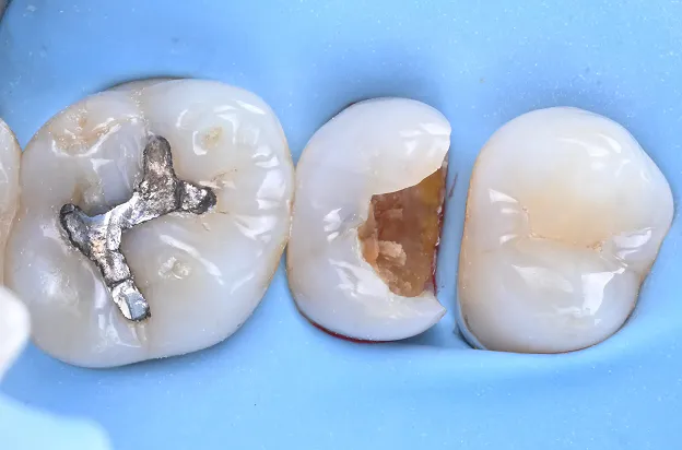 오래가는 인레이를 위한 테크닉 | 레진코어 수복 Resin Core Build-up