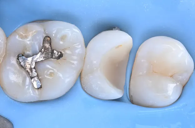오래가는 인레이를 위한 테크닉 | 레진코어 수복 Resin Core Build-up