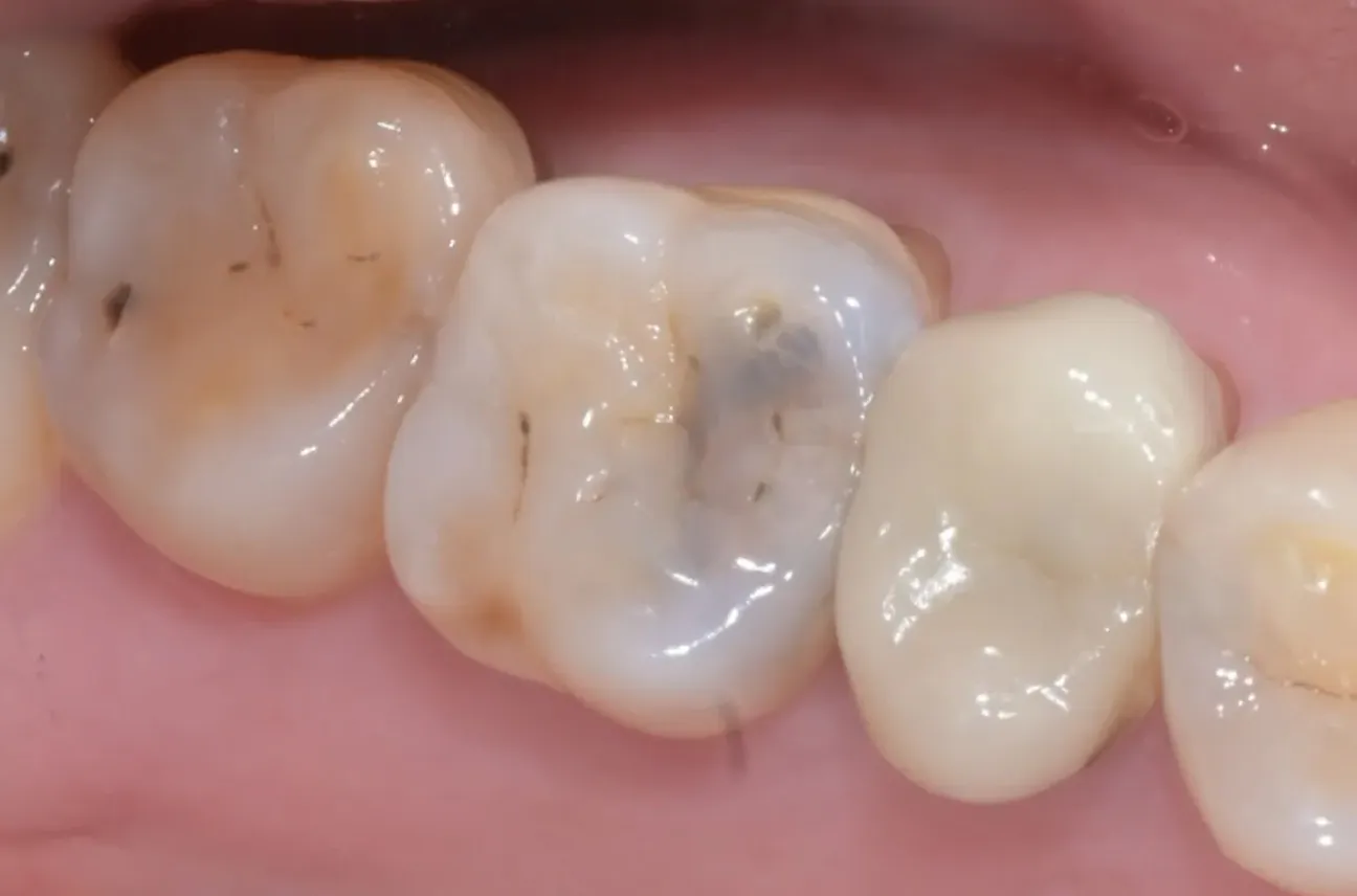 미니크라운 (오버레이) 적용 가능 치아 | 충치가 생긴 치아(치아우식증 Caries)