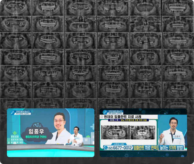 고난이도 전체 임플란트 수술 | 경험의 차이로 증명