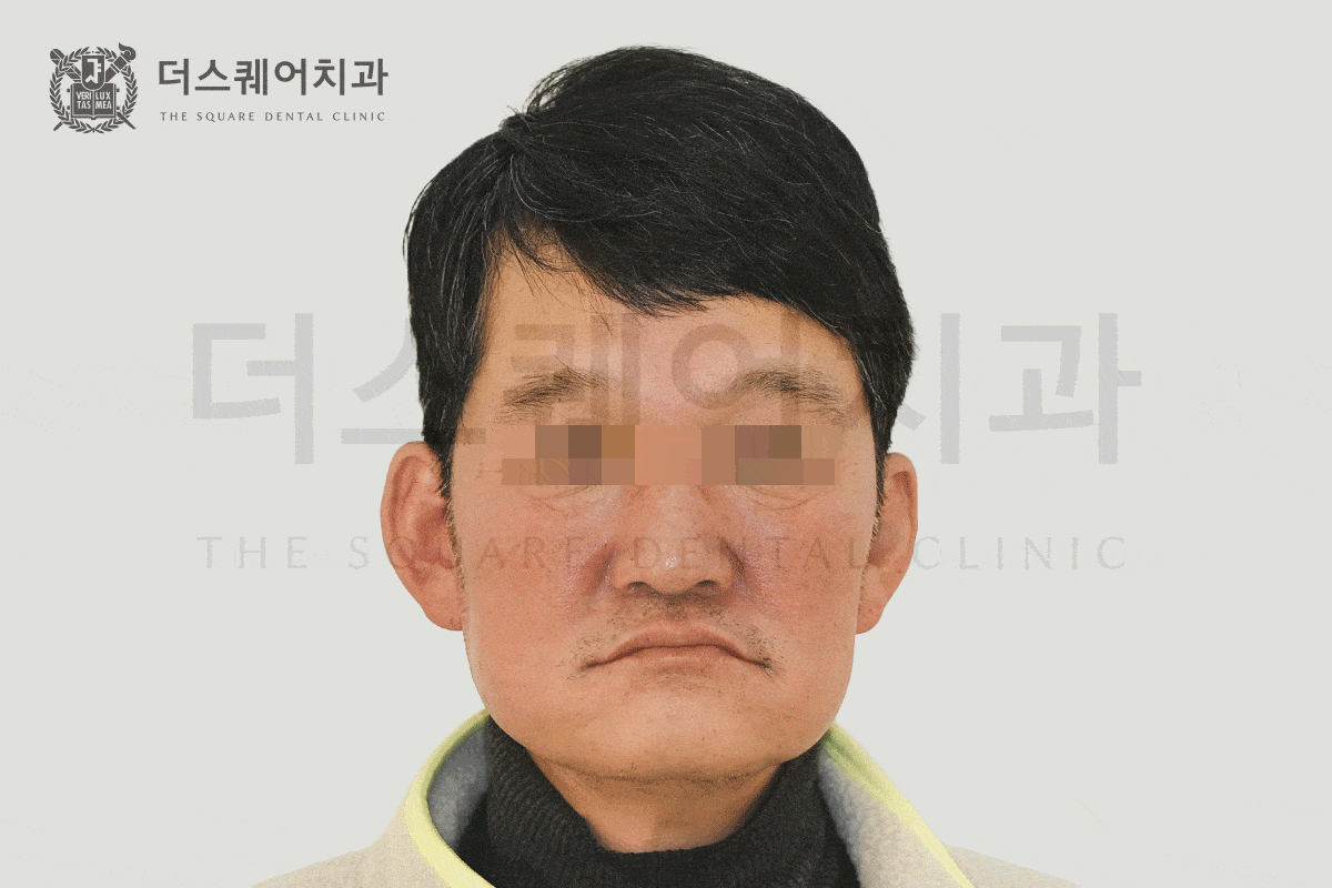 삶의 질을 바꾸는 전체 임플란트