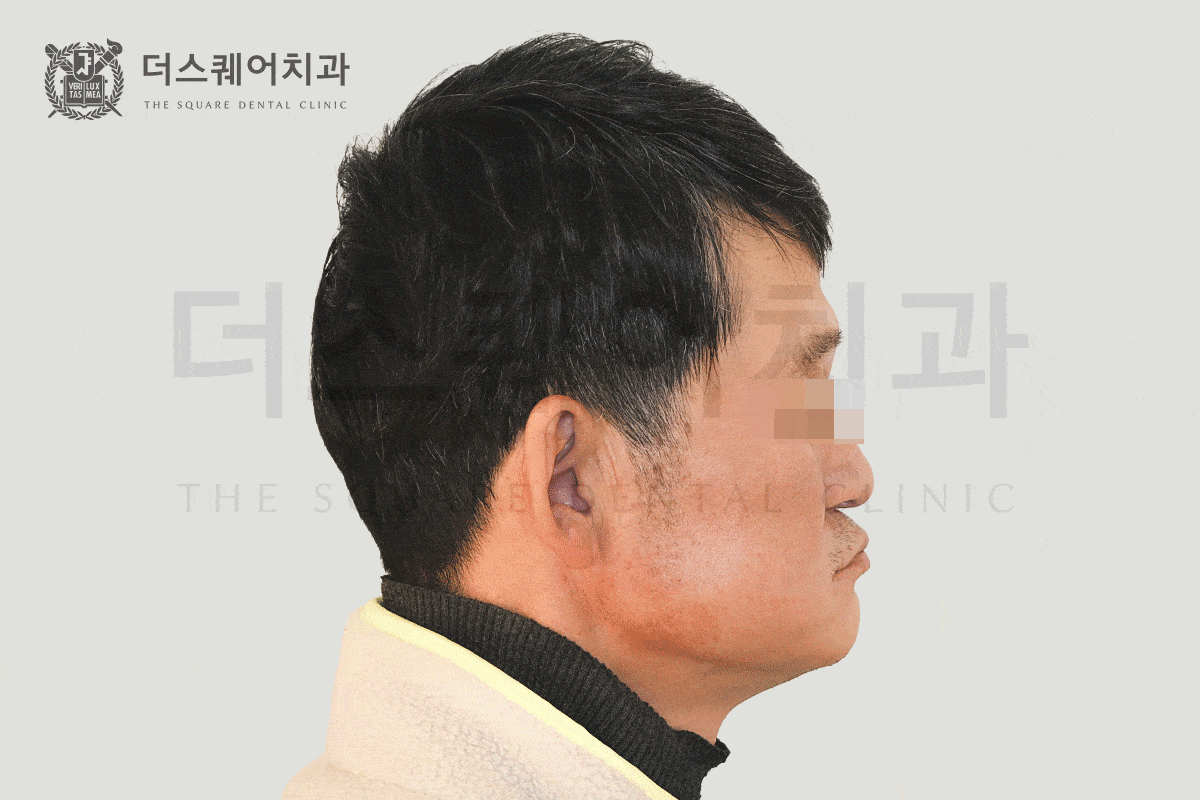 삶의 질을 바꾸는 전체 임플란트