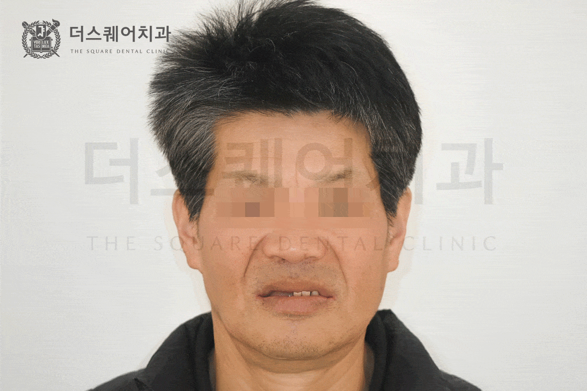 삶의 질을 바꾸는 전체 임플란트