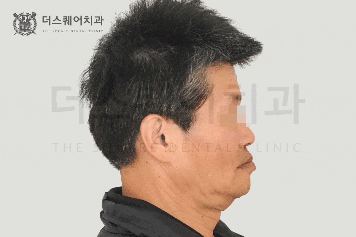 삶의 질을 바꾸는 전체 임플란트