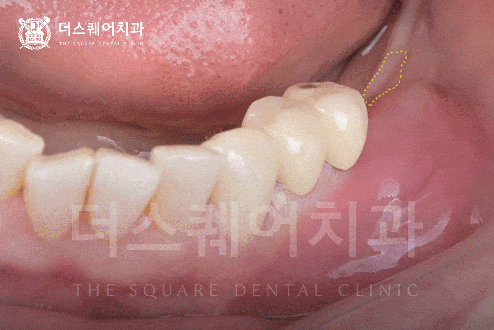 전체 임플란트 정답 | 하루 만에 치아가 생기는 원데이 임플란트