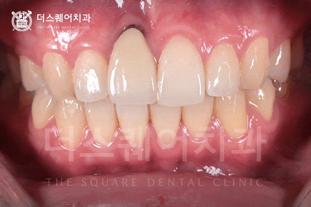 전체 임플란트 정답 | 하루 만에 치아가 생기는 원데이 임플란트