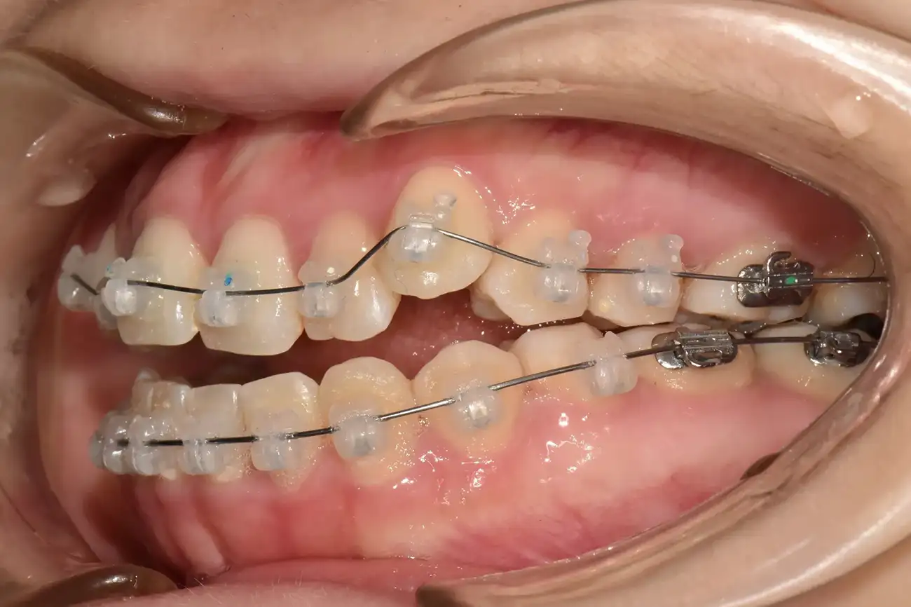 와이어 미세 조절을 통한 디테일한 치아 컨트롤 | Wiring