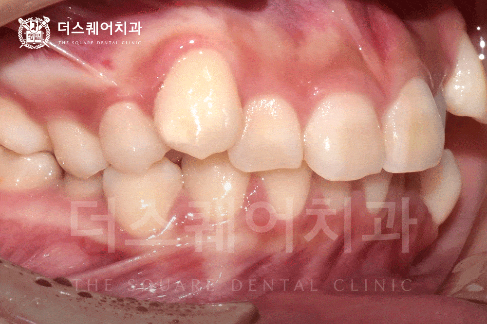 자연치아 수명을 늘려주는 진짜 교정