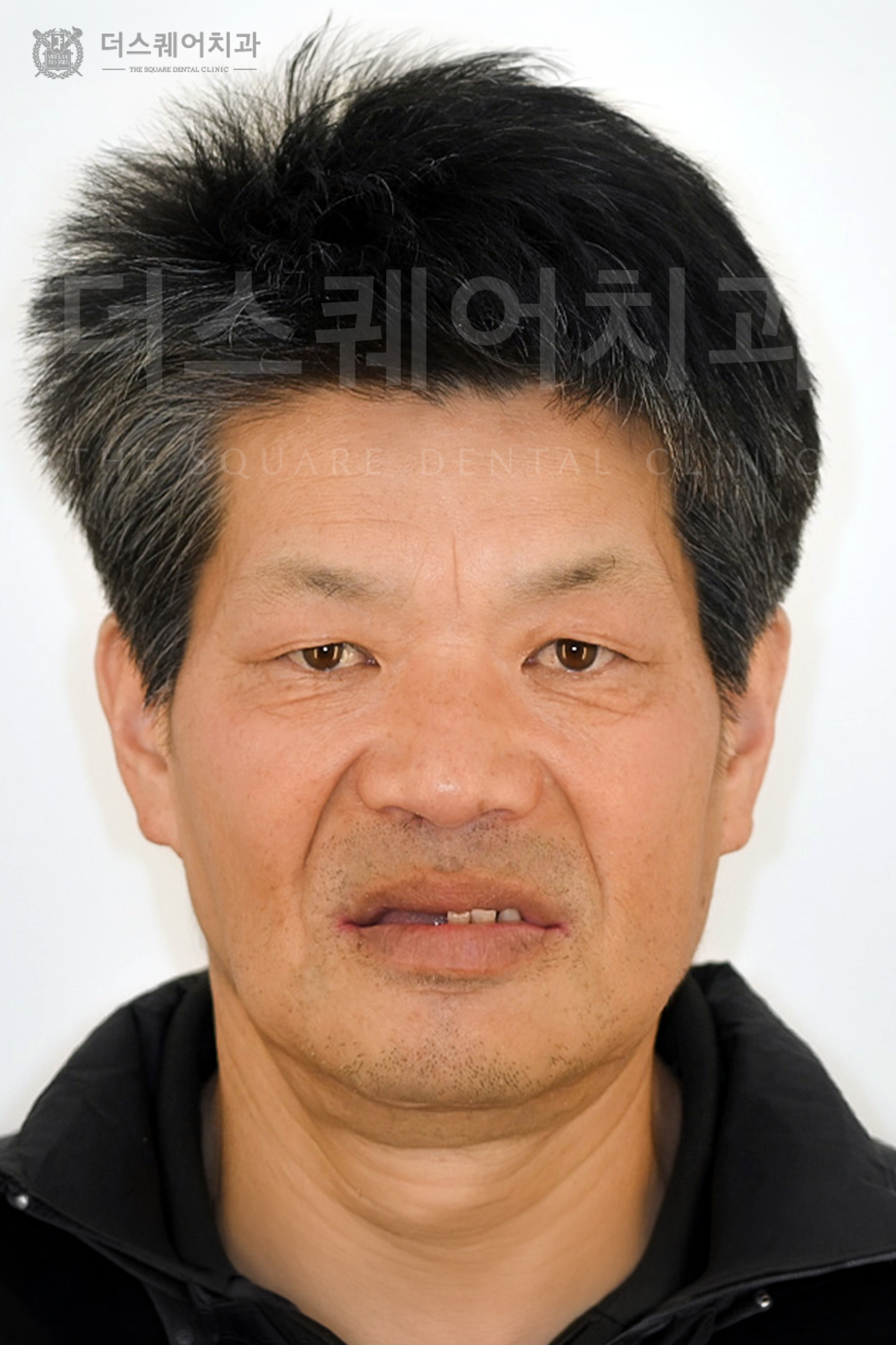 전체 임플란트로 회복한 치아와 안모변화