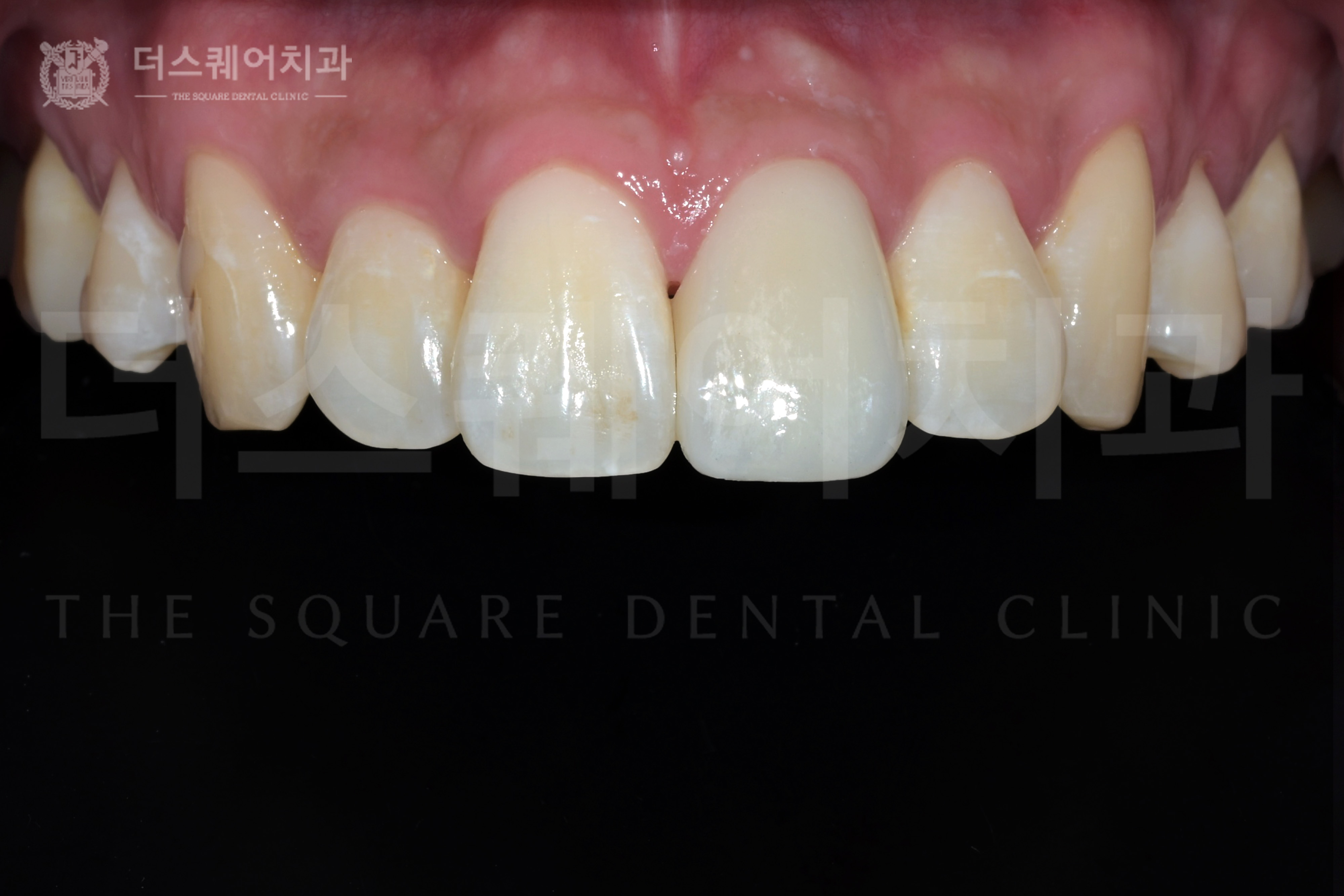 <br />
<b>Warning</b>:  Undefined variable $ba_title in <b>/home/thesquaredc.co.kr/clinical-case/clinicalcase.php</b> on line <b>608</b><br />
