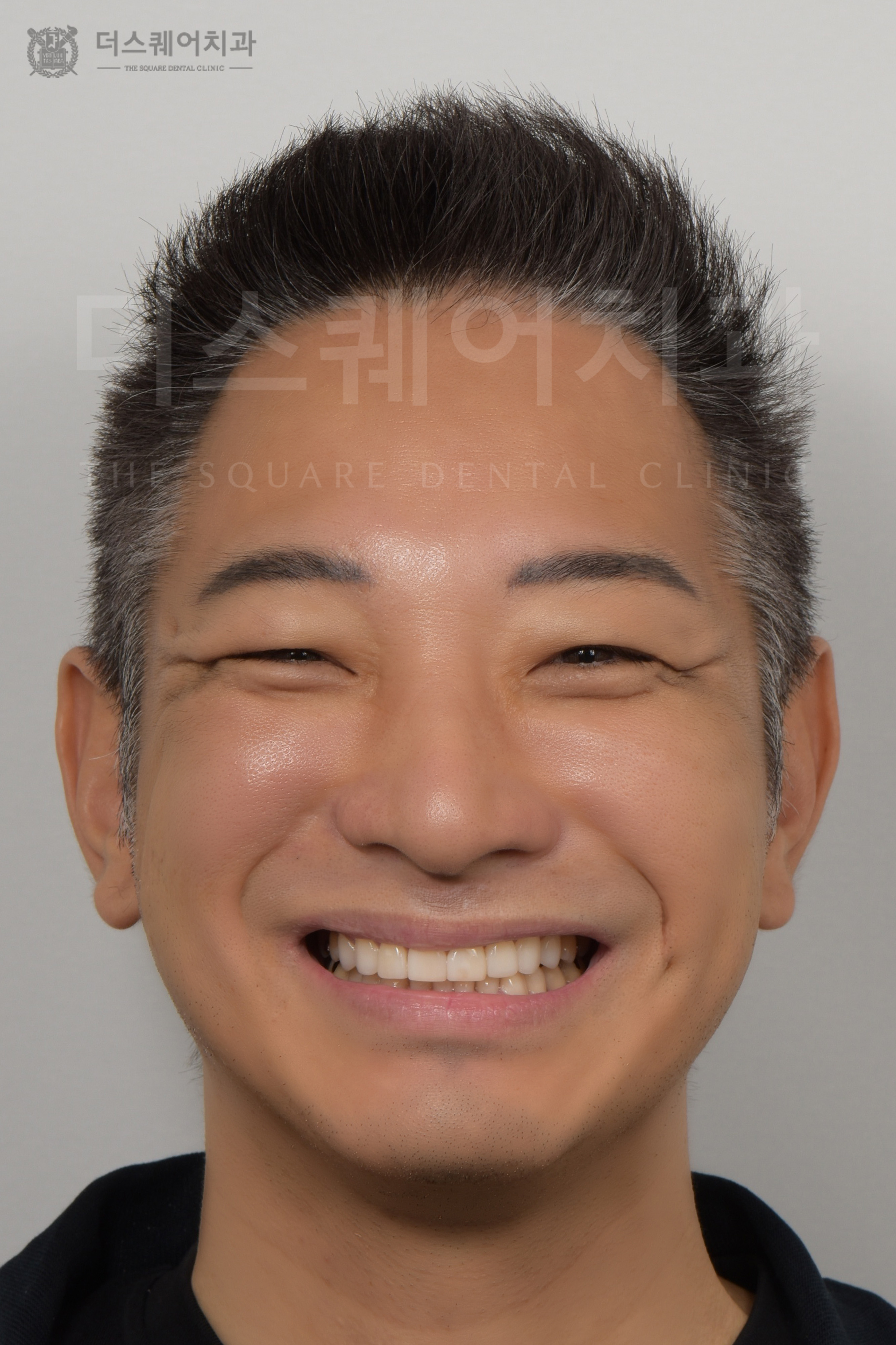 損傷・変色・歯並びの乱れを改善するためのベニアキューブ審美治療