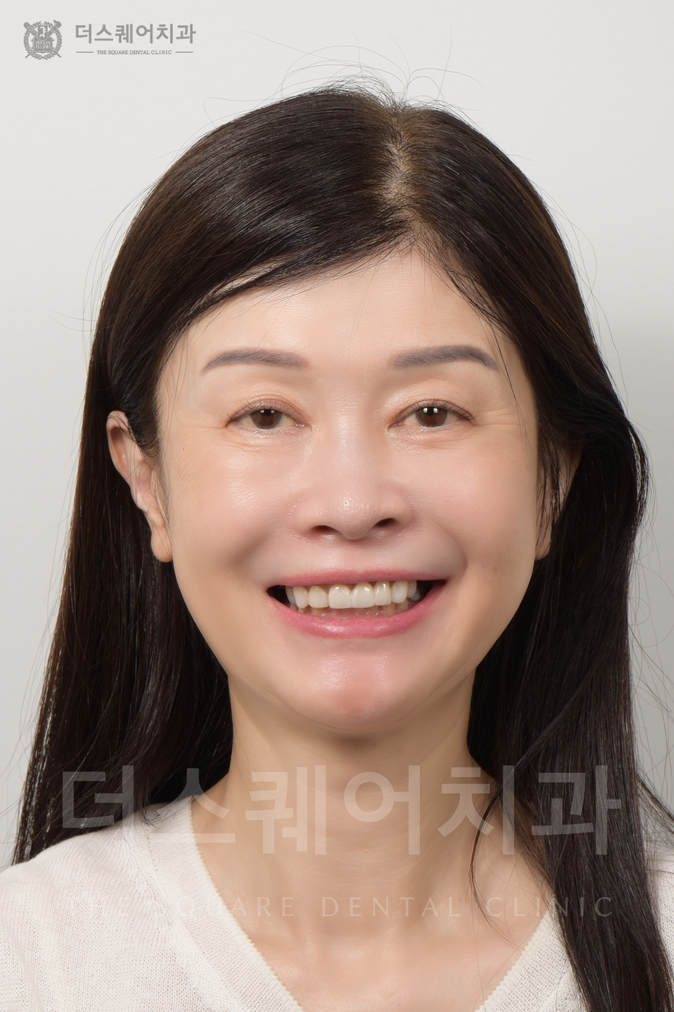 앞니 재치료, 손상, 변색, 틀어진 치아 복구를 위한 비니어큐브 심미치료 