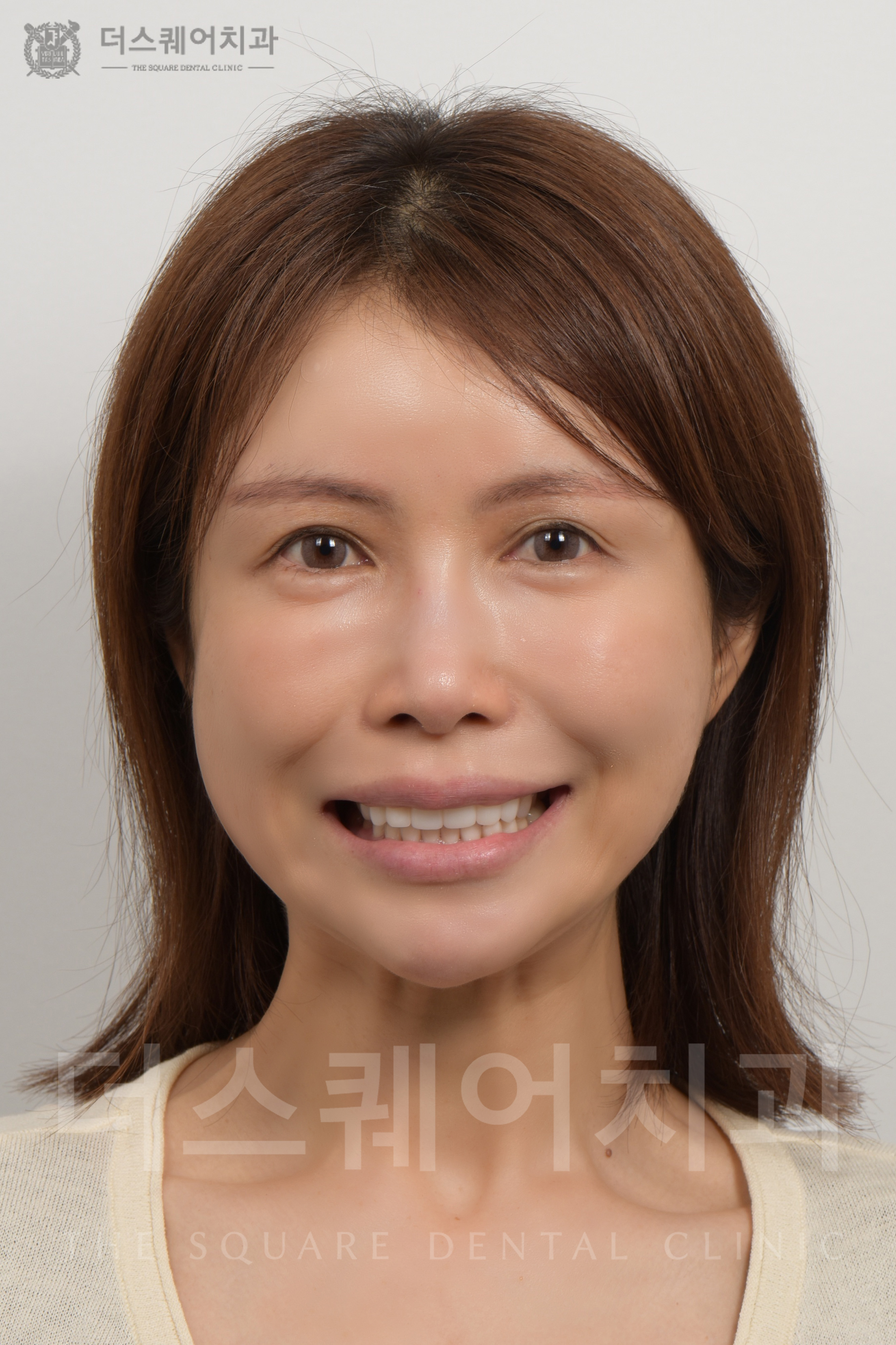 損傷・変色した歯の修復を目的としたベニアキューブ審美治療