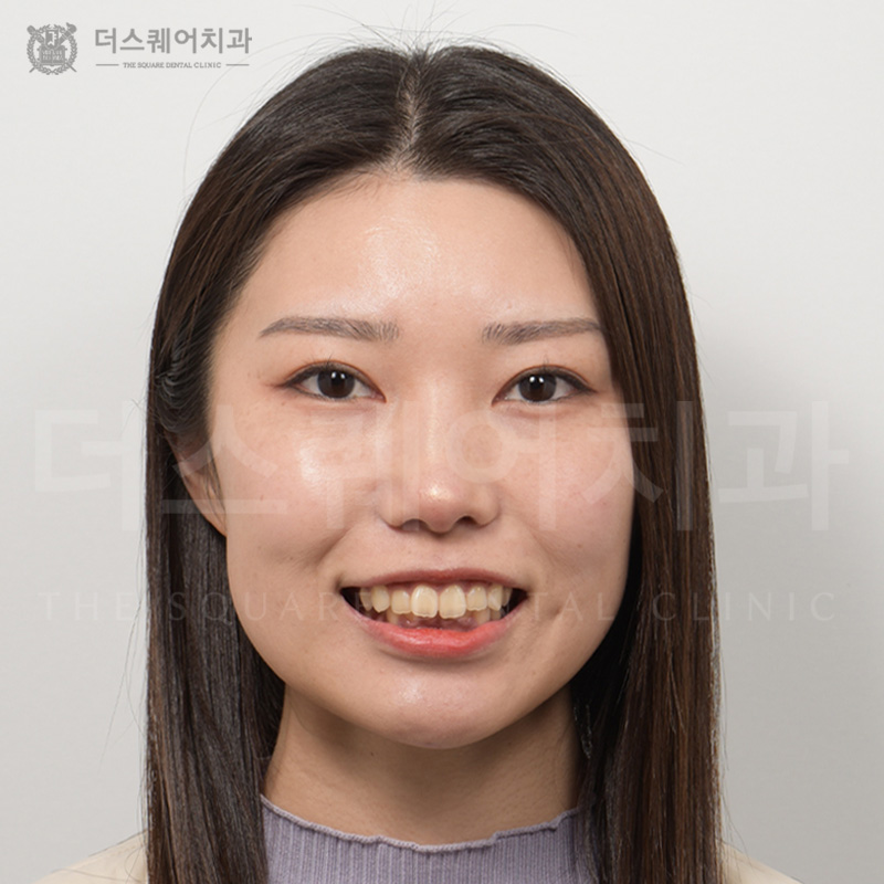 틀어진 치아, 변색된 치아를 비니어큐브로 치아복구