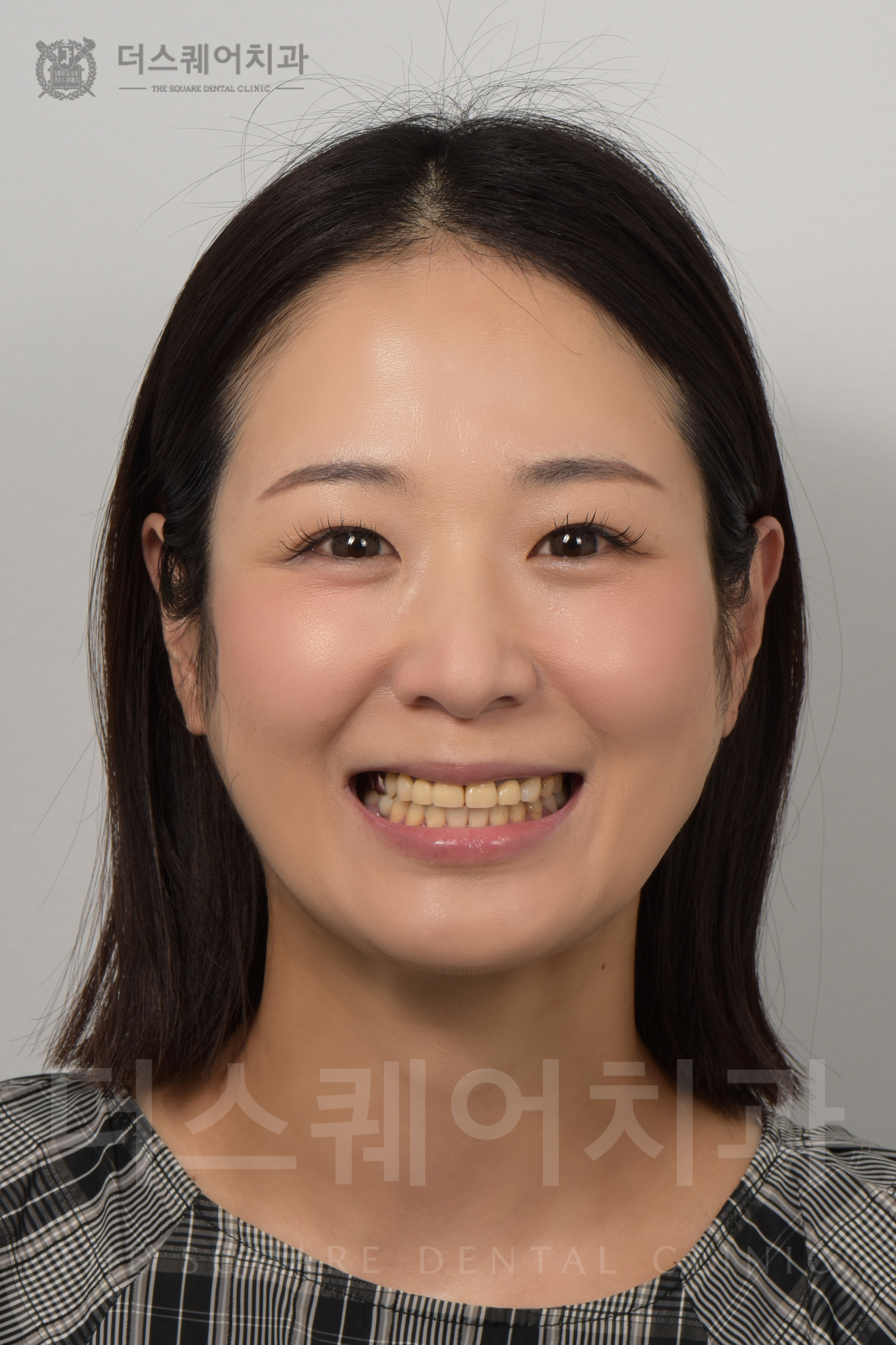 損傷・変色した歯の修復を目的としたベニアキューブ審美治療