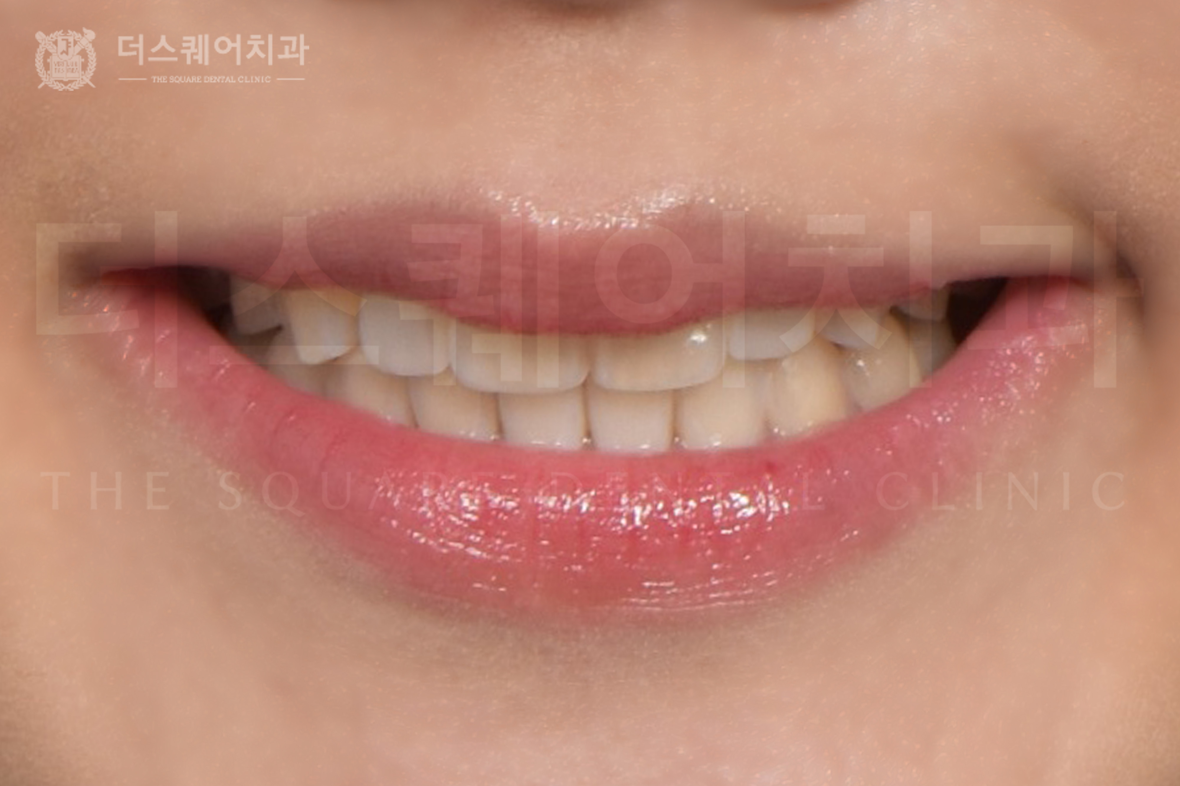 <br />
<b>Warning</b>:  Undefined variable $ba_title in <b>/home/thesquaredc.co.kr/clinical-case/clinicalcase.php</b> on line <b>608</b><br />
