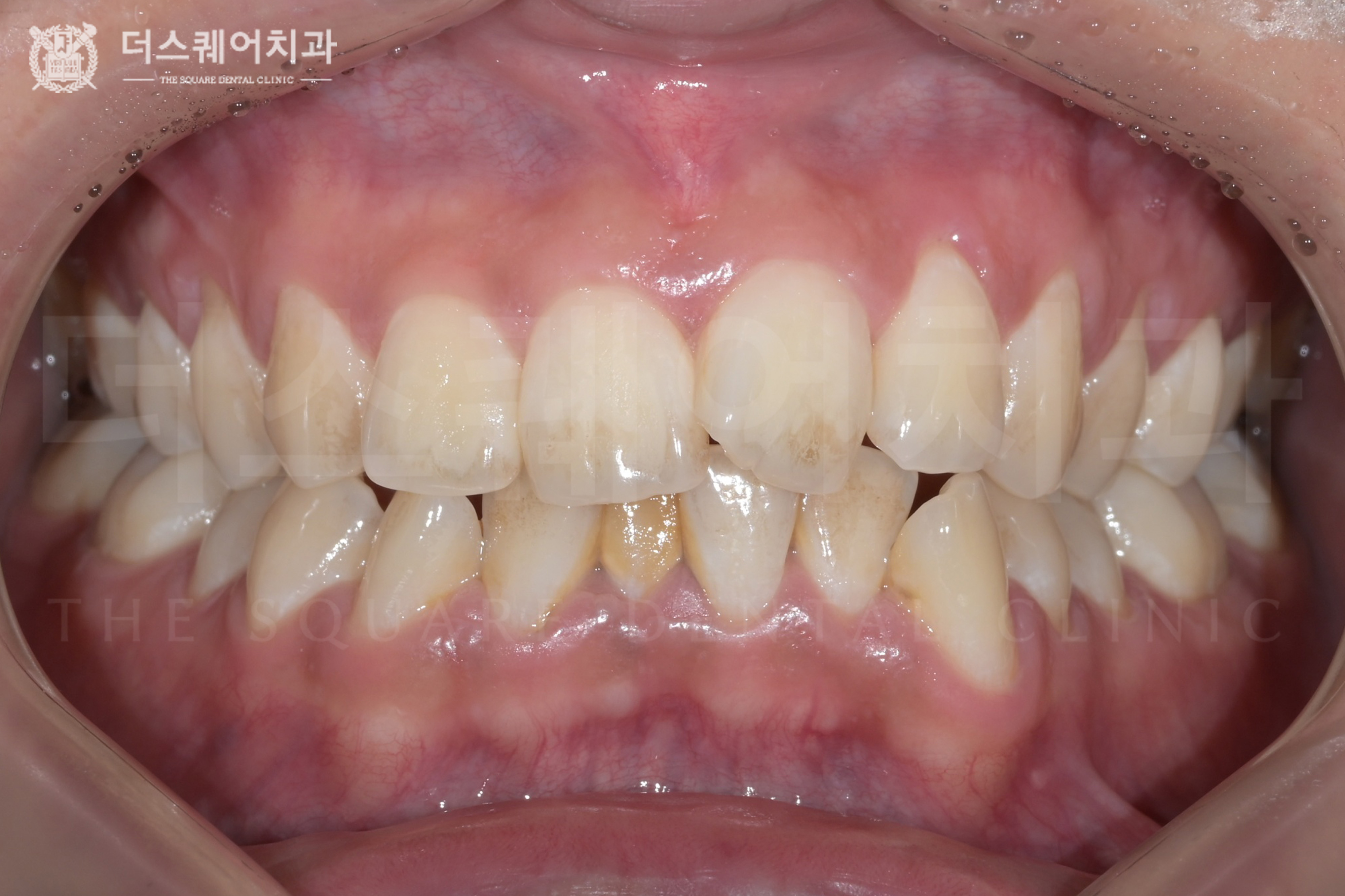 누런 치아를 밝고 환하게 개선한 치아미백