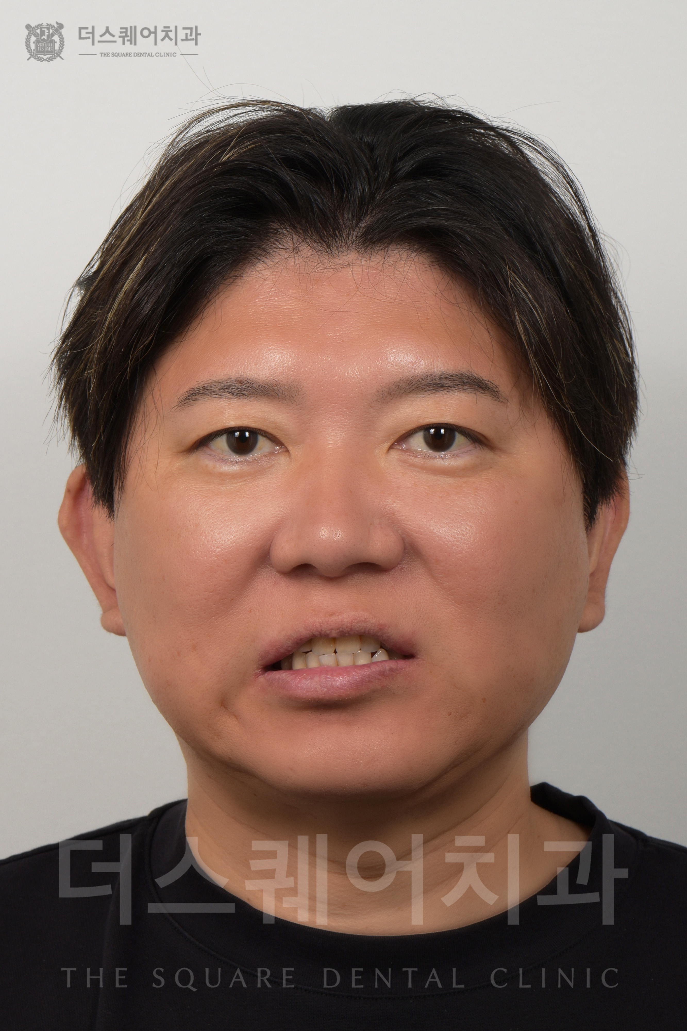 덧니, 배열, 변색된 치아 복구를 위한 비니어큐브 심미치료