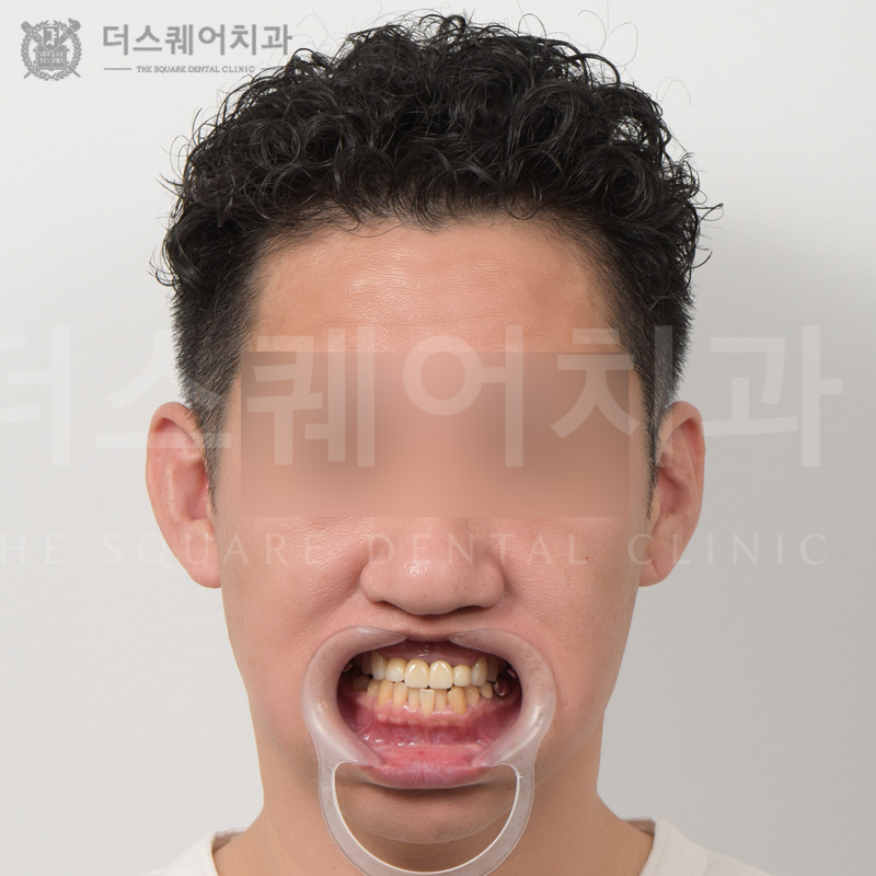 <br />
<b>Warning</b>:  Undefined variable $ba_title in <b>/home/thesquaredc.co.kr/clinical-case/clinicalcase.php</b> on line <b>608</b><br />
